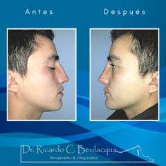 Rinoplastia - Dr. Ricardo C. Bevilacqua