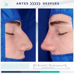 Rinoplastia - Dr. Ricardo C. Bevilacqua