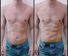 Marcado de abdomen - Esthetics One