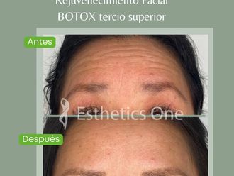 Botox antes y después - 870299