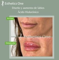 Relleno de labios - Esthetics One