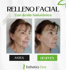 Rellenos faciales - Esthetics One