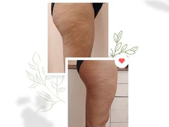 Tratamientos celulitis antes y después - 870308