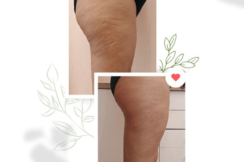 Tratamientos celulitis antes y después - 870308