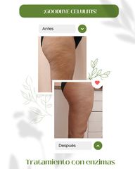 Celulitis - Esthetics One