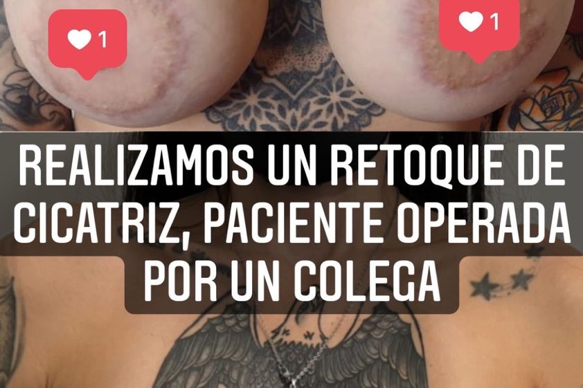 Eliminar cicatrices antes y después - 826258