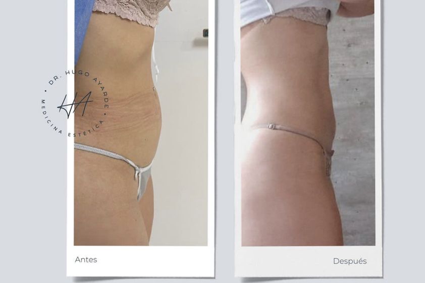 Abdominoplastía antes y después - 826262