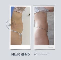 Abdominoplastia - Dr. Hugo Ayarde