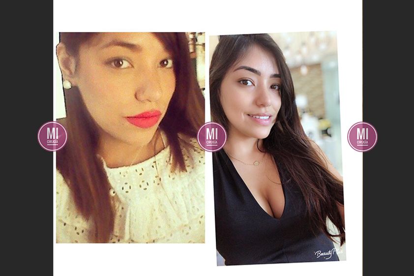 Cirugía de pómulos antes y después - 631092