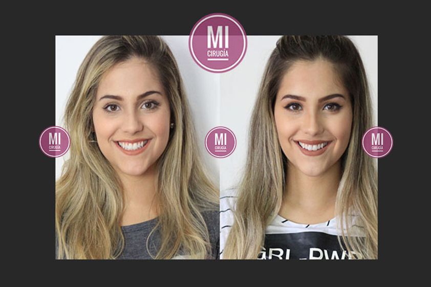 Cirugía de pómulos antes y después - 631093