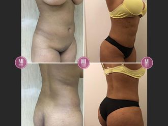 Liposucción - 633014