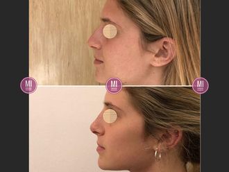 Rinoplastia - 633015