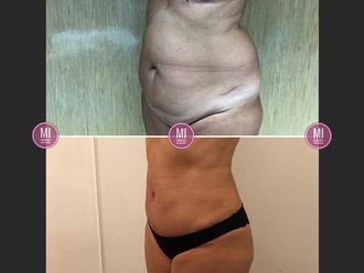 Dermolipectomía - 633926