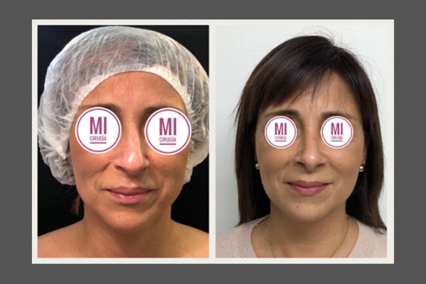 Mentoplastia antes y después - 634948