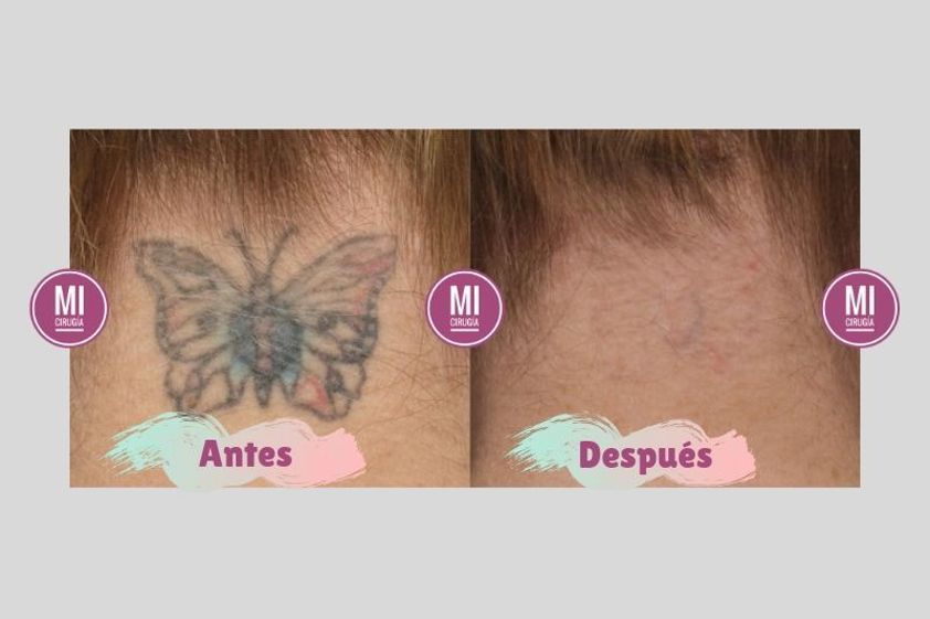 Borrar tatuajes antes y después - 640188
