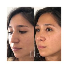 Postoperatorio Rinoplastia Antes y Después