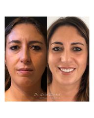 Rinoplastia Antes y Después