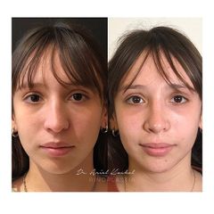 Rinoplastia - Dr. Ariel Kochol