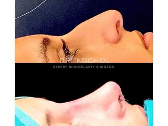 Rinoplastia antes y después - 738559