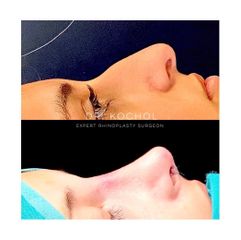 Rinoplastia - Dr. Ariel Kochol