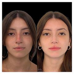 Rinoplastia - Dr. Ariel Kochol