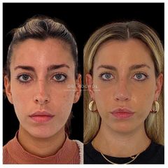 Rinoplastia - Dr. Ariel Kochol