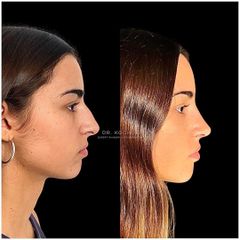 Rinoplastia - Dr. Ariel Kochol