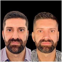 Rinoplastia - Dr. Ariel Kochol