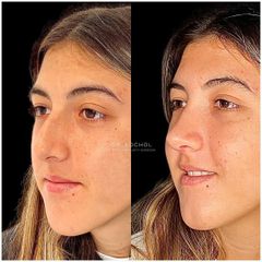 Rinoplastia - Dr. Ariel Kochol