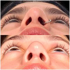 Rinoplastia - Dr. Ariel Kochol