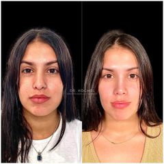 Rinoplastia - Dr. Ariel Kochol