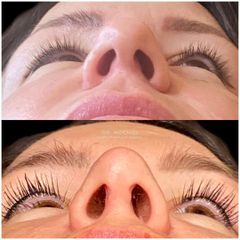 Rinoplastia - Dr. Ariel Kochol