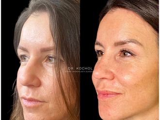 Rinoplastia antes y después - 857072