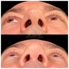 Rinoplastia - Dr. Ariel Kochol