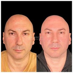 Rinoplastia - Dr. Ariel Kochol