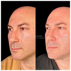 Rinoplastia - Dr. Ariel Kochol