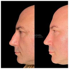 Rinoplastia - Dr. Ariel Kochol