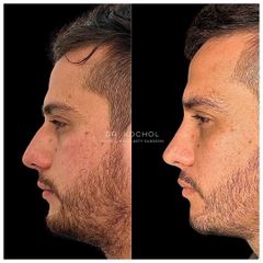 Rinoplastia - Dr. Ariel Kochol