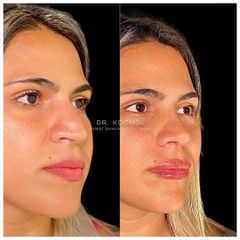 Rinoplastia - Dr. Ariel Kochol