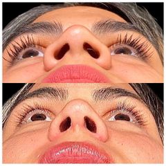 Rinoplastia - Dr. Ariel Kochol