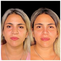 Rinoplastia - Dr. Ariel Kochol