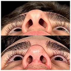 Rinoplastia - Dr. Ariel Kochol