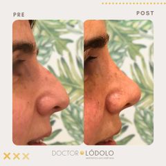 Rinoplastia - Doctor Lódolo