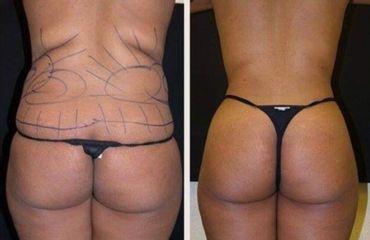 Liposucción - Dr. Montes Miguel