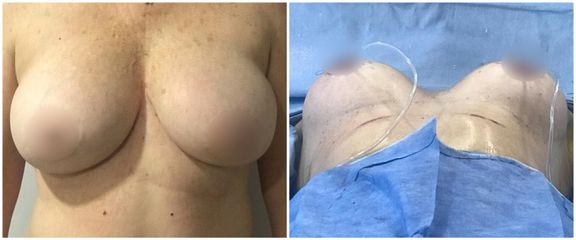 Mastopexia - Dr. Montes Miguel