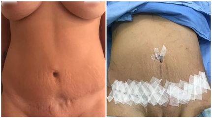 Abdominoplastia - Dr. Montes Miguel