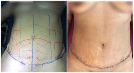 Abdominoplastia - Dr. Montes Miguel