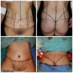 Abdominoplastia - Dr. Montes Miguel