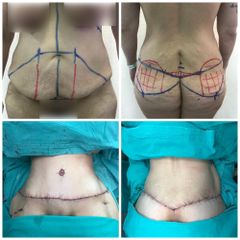 Abdominoplastia - Dr. Montes Miguel