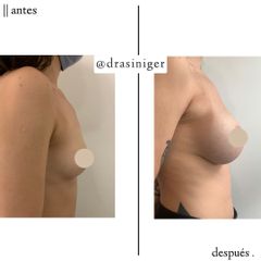 aumento de mamas - Dra. Tatiana Siniger
